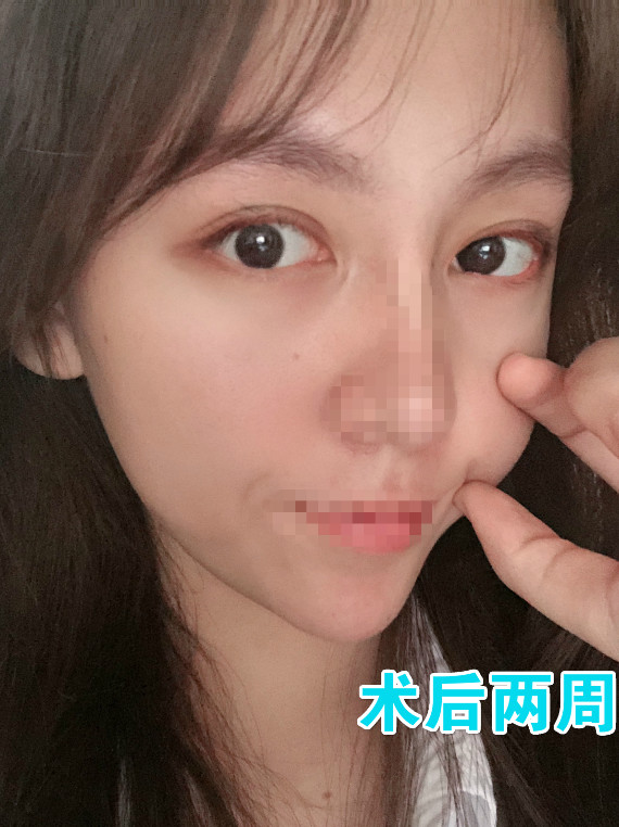 和埋线双眼皮比,全切术士肿胀期更长一些,比如说增生期,全切双眼皮后