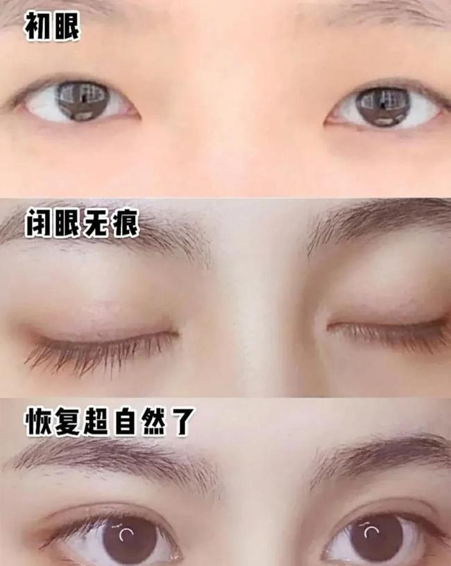 割双眼皮要多久才能恢复自然?