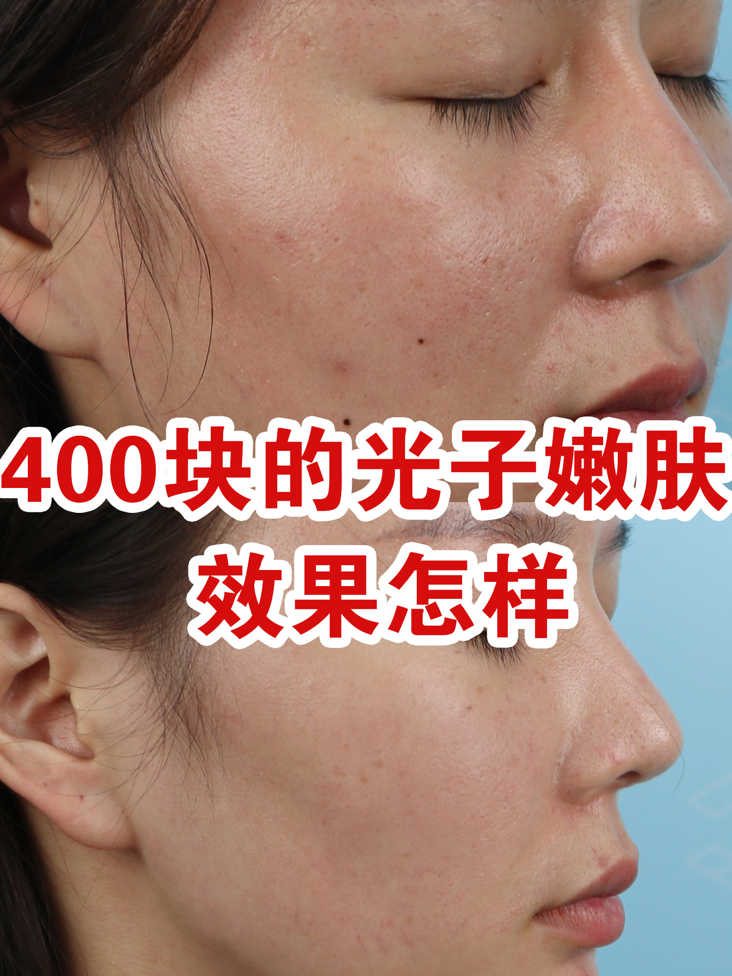 400块钱的光子嫩肤效果怎样