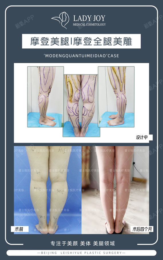 手术方案: 摩登全腿美雕,即大腿吸脂,小腿吸脂,膝盖吸脂,膝内侧填充