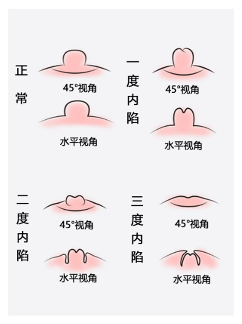 乳头内陷的的不同度数与伴生分瓣的形状