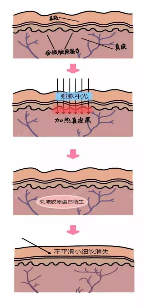 光子嫩肤的原理