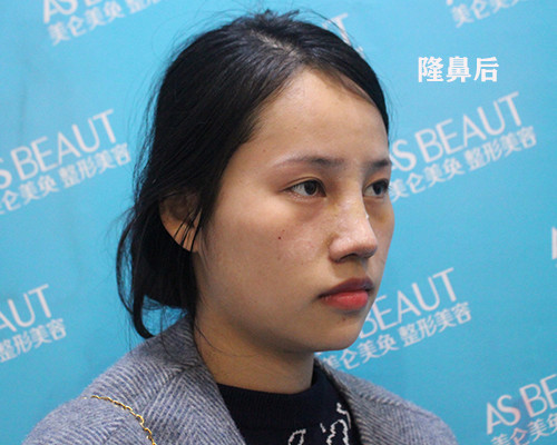 塌鼻子逆袭挺翘鼻