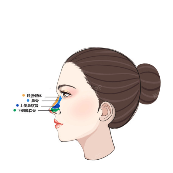 2,自体软骨隆鼻