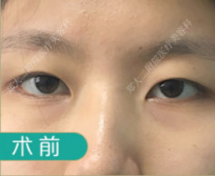 眼皮下垂明显,眼睛很小