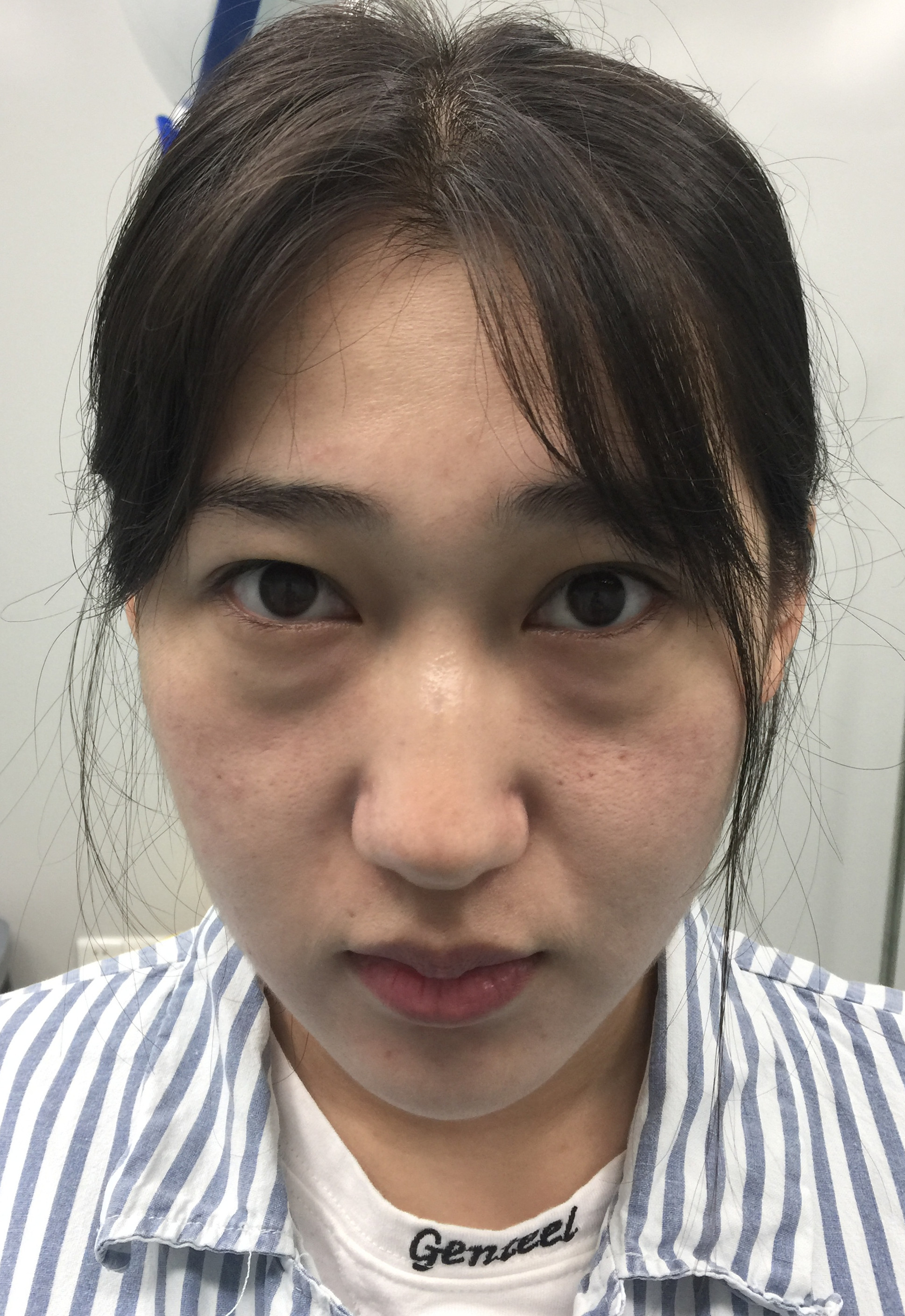 眼袋,轻微黑眼圈,眼周皮肤松弛