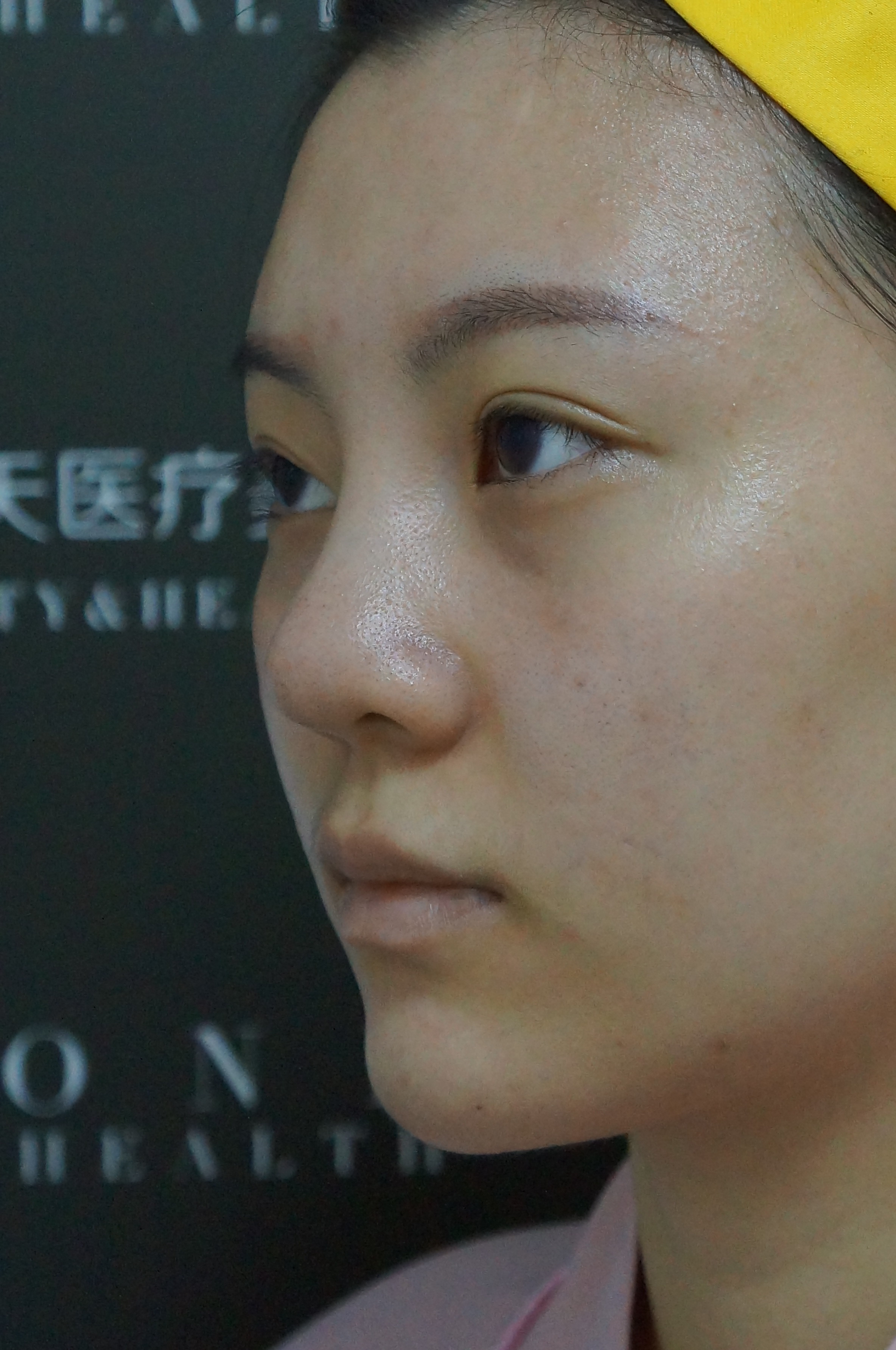 鼻子整体偏短,之前做过硅胶,有挛缩.