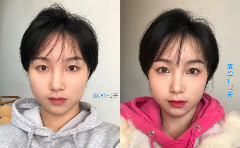 咬肌肥大面部轮廓看起来比较宽