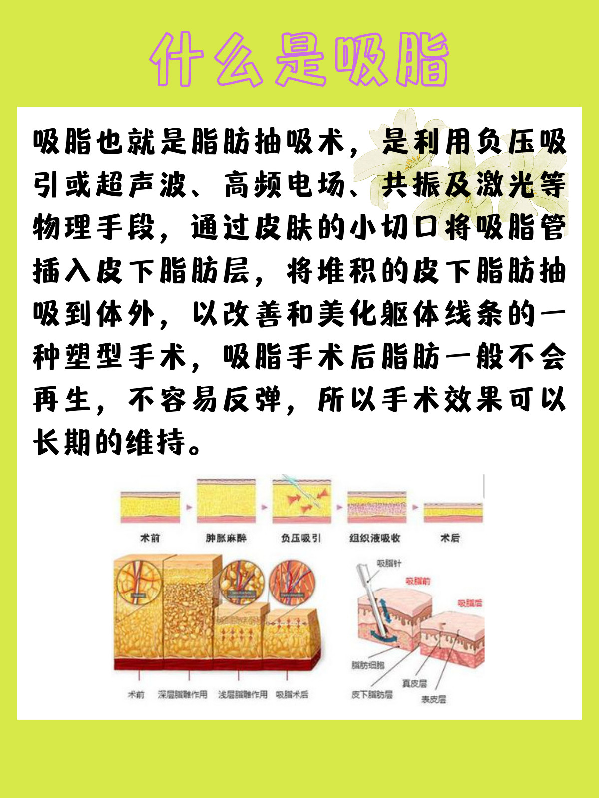 有关于吸脂你所要了解的吸脂也就是脂肪抽吸术,是利用_圈子-新氧美容