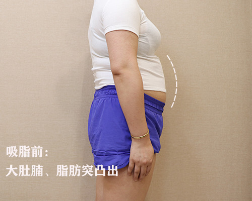 减减减,吸脂专减腰腹赘肉术前诊断腰部两侧赘肉凸出,_圈子-新氧美容