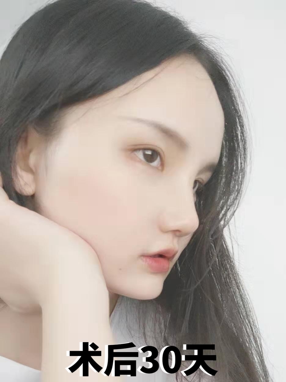 玻尿酸隆鼻vs鼻部多项#术前分析典型短鼻,鼻尖矮塌