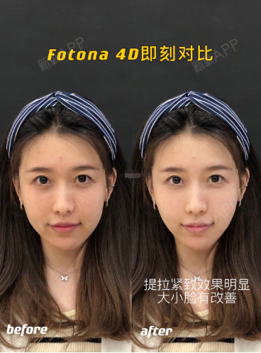 fotona4d欧洲之星真实体验,抗衰效果如何