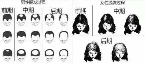 正常情况下一个人每天掉落的头发在100根以内都属于正常现象,超过