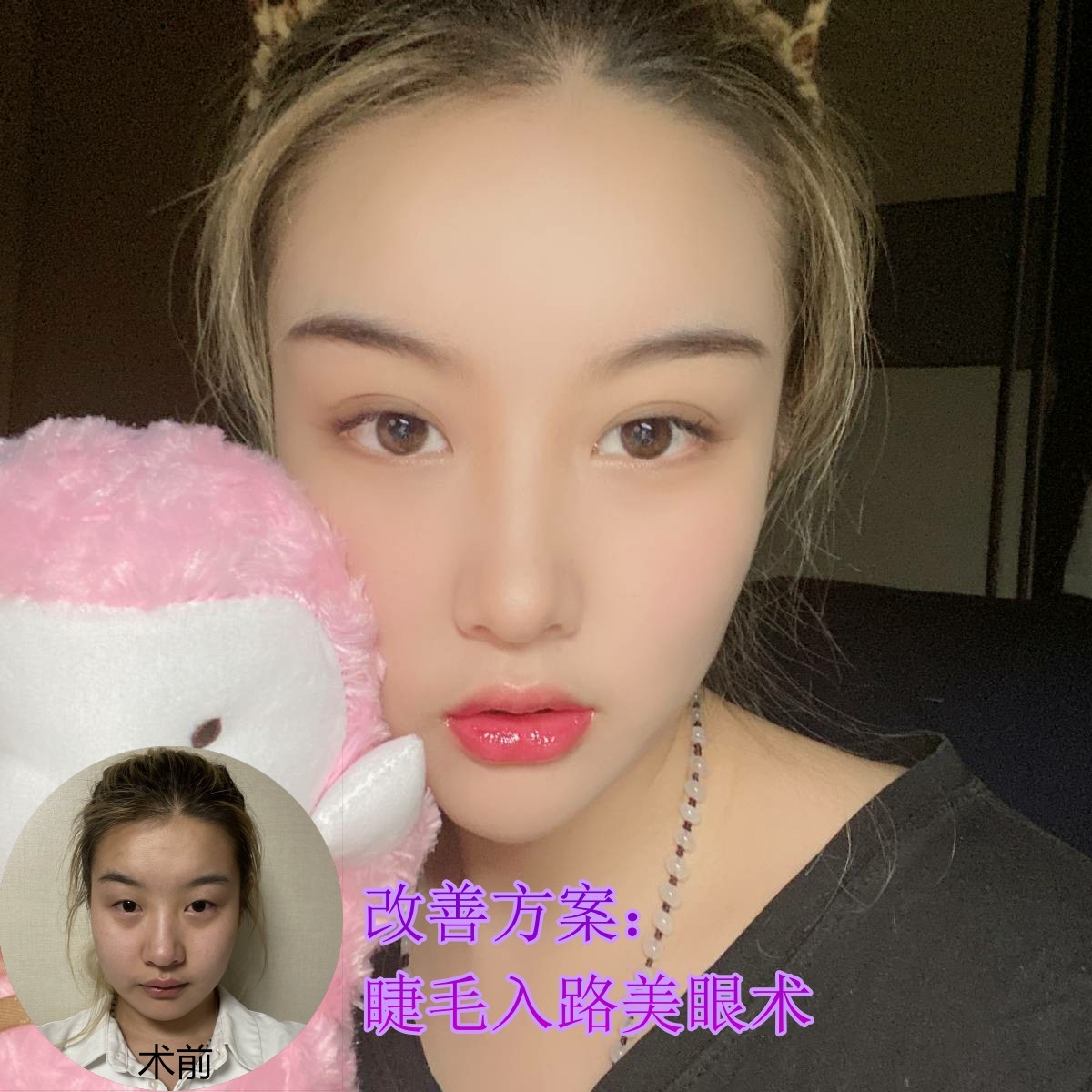 肿眼泡要怎么改善?