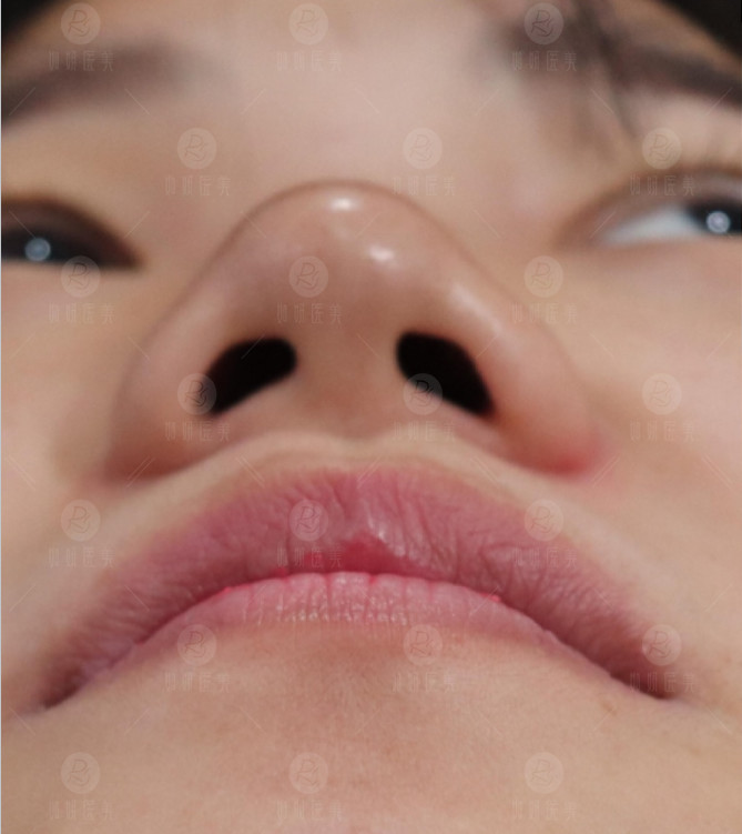 患者鼻部鼻翼宽大,扁塌且一侧鼻基底凹陷严重,低鼻