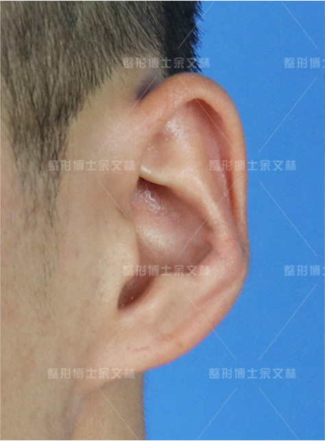 术前经诊断为反骨耳