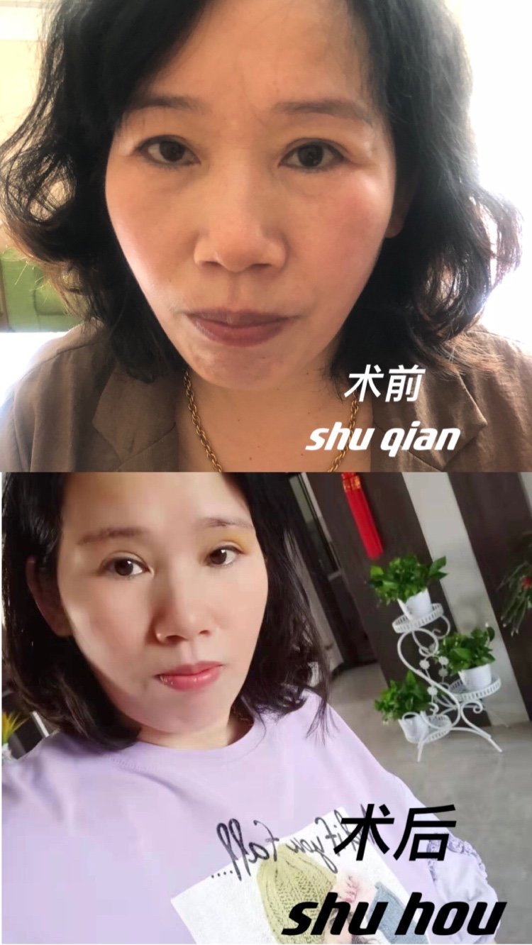 提眉术