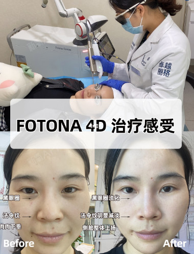 欧洲之星fotona 4d 治疗真实体验,效果也太好了吧