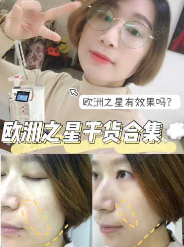 欧洲之星fotona 4d效果和攻略