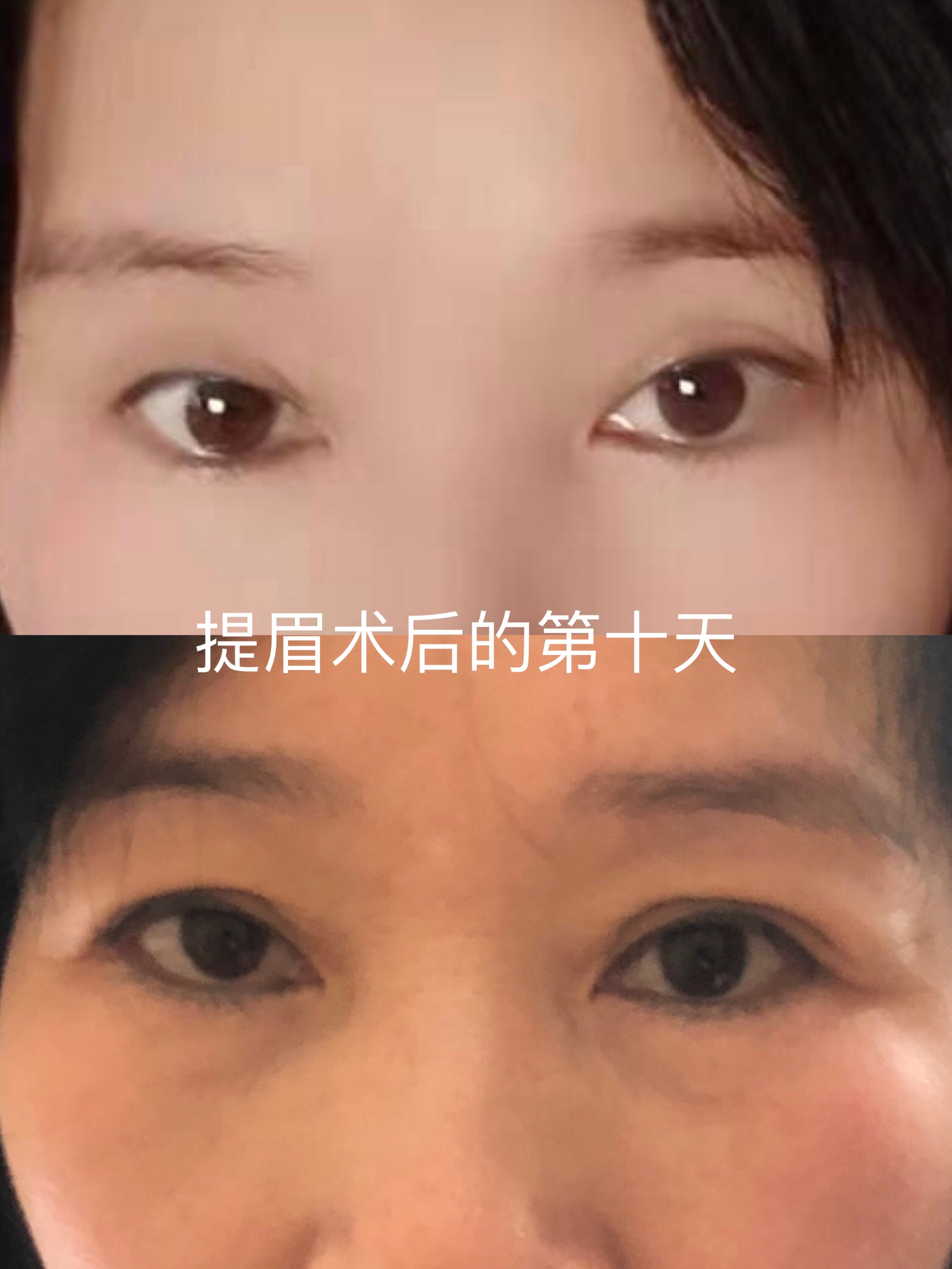 家人们,你们如果去做了这个提眉手术,一定要看我的建议哟!但是伤口有