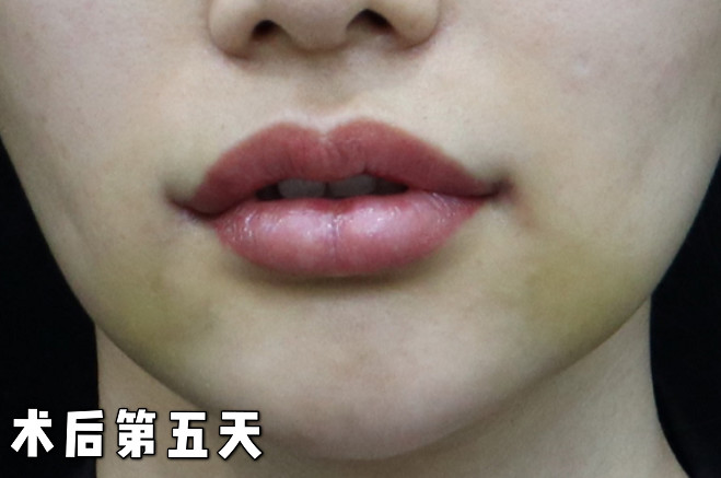 精致唇综合案例分享:术前:上下唇的厚度比例其实是很_圈子-新氧美容