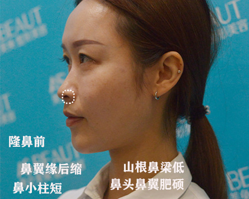 矫正鼻孔外露垫高鼻梁鼻背稳固完美鼻型自由揉捏#7月