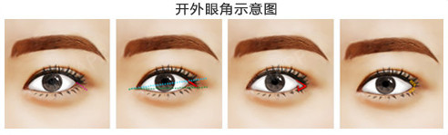 开内眼角和开外眼角有什么区别