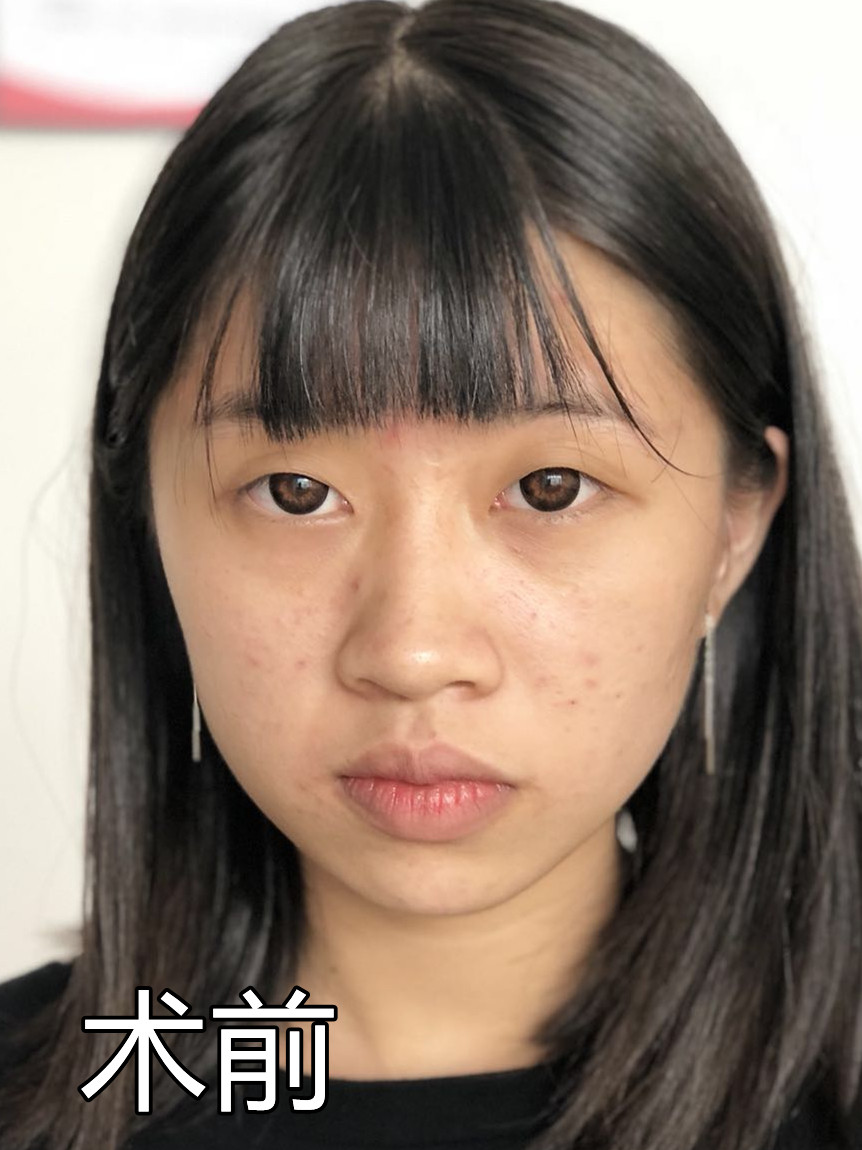 单眼皮眼窝凹陷,怎么变好看?