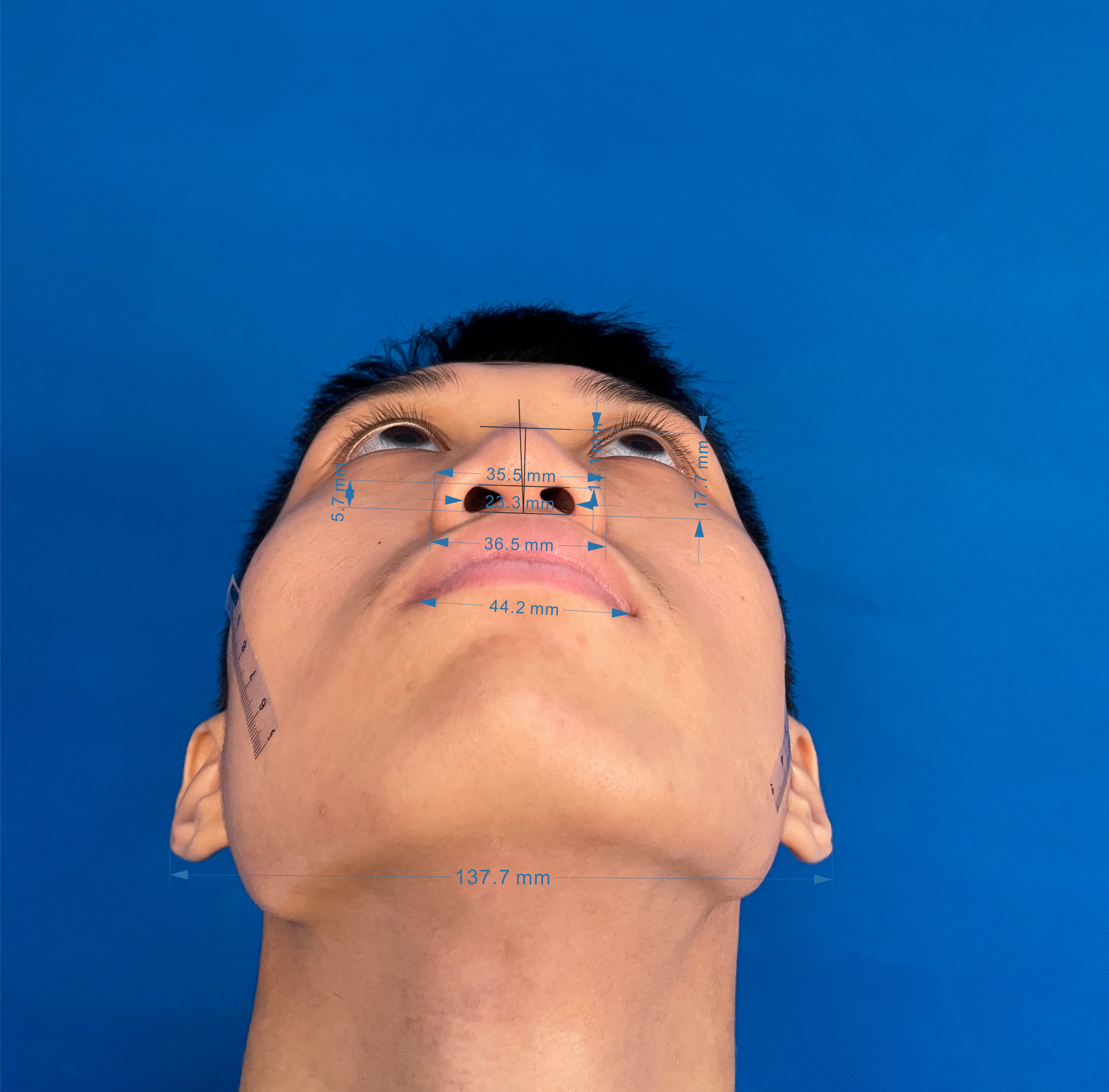 2,鼻尖突出度重度不足,鼻小柱过短伴退缩畸形;3,驼峰鼻;4,鼻头肥大;5