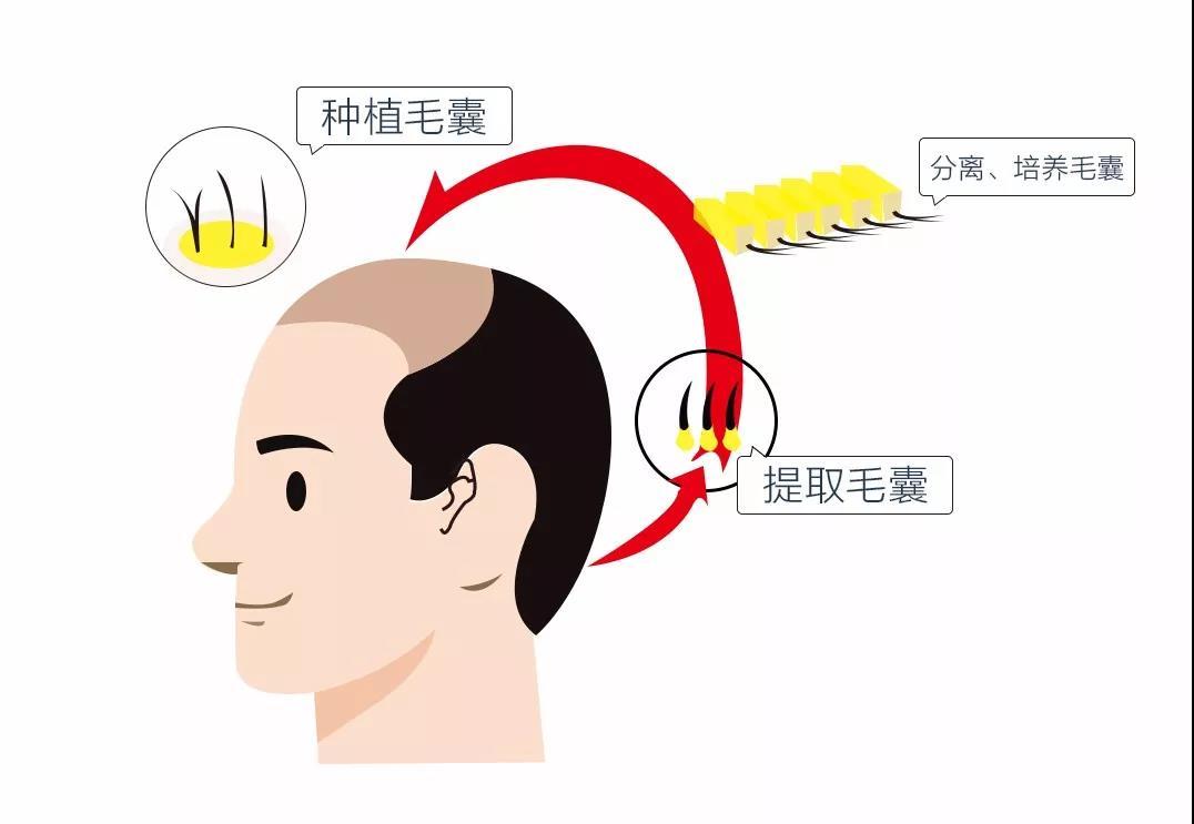 在后枕部提取毛囊,后枕部会不会秃