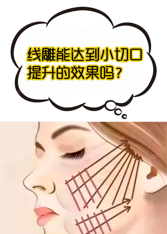 【线雕能达到小切口提升的效果吗?】