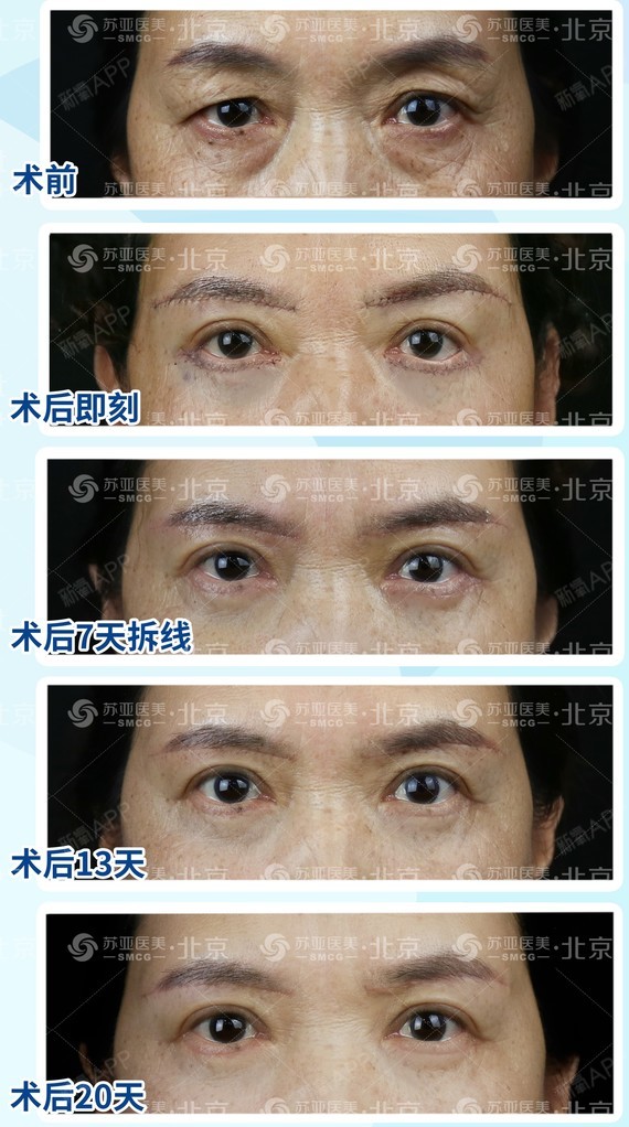 (2)双侧眼睛不对称:左侧眼睛上眼睑松弛下垂严重导致眼睛呈现三角状
