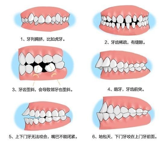 比如个别牙齿出现错位萌出,牙弓形态以及牙齿出现排列异常,牙齿前突