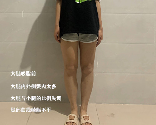 下半身比较臃肿肥胖,大腿外侧凸出,大腿内侧脂肪堆积过度,两腿直减的