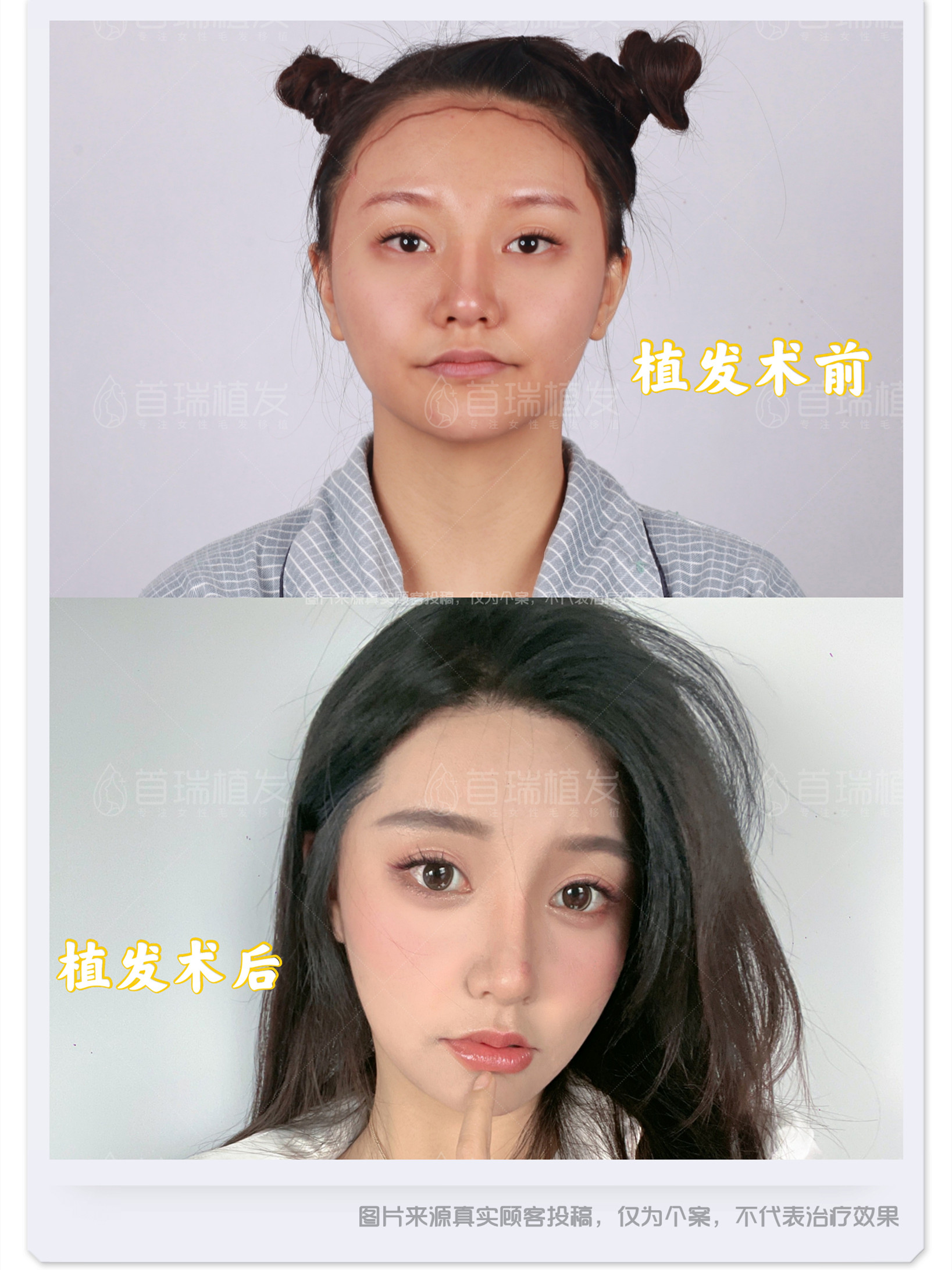 71很多发质不太好,但又想植发的女生普遍都存在一种疑_圈子-新氧