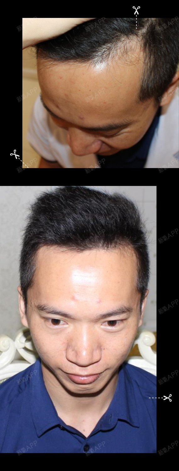 植发67脱发前的额角后移情况很严重,现在植发后恢复_圈子-新氧美容