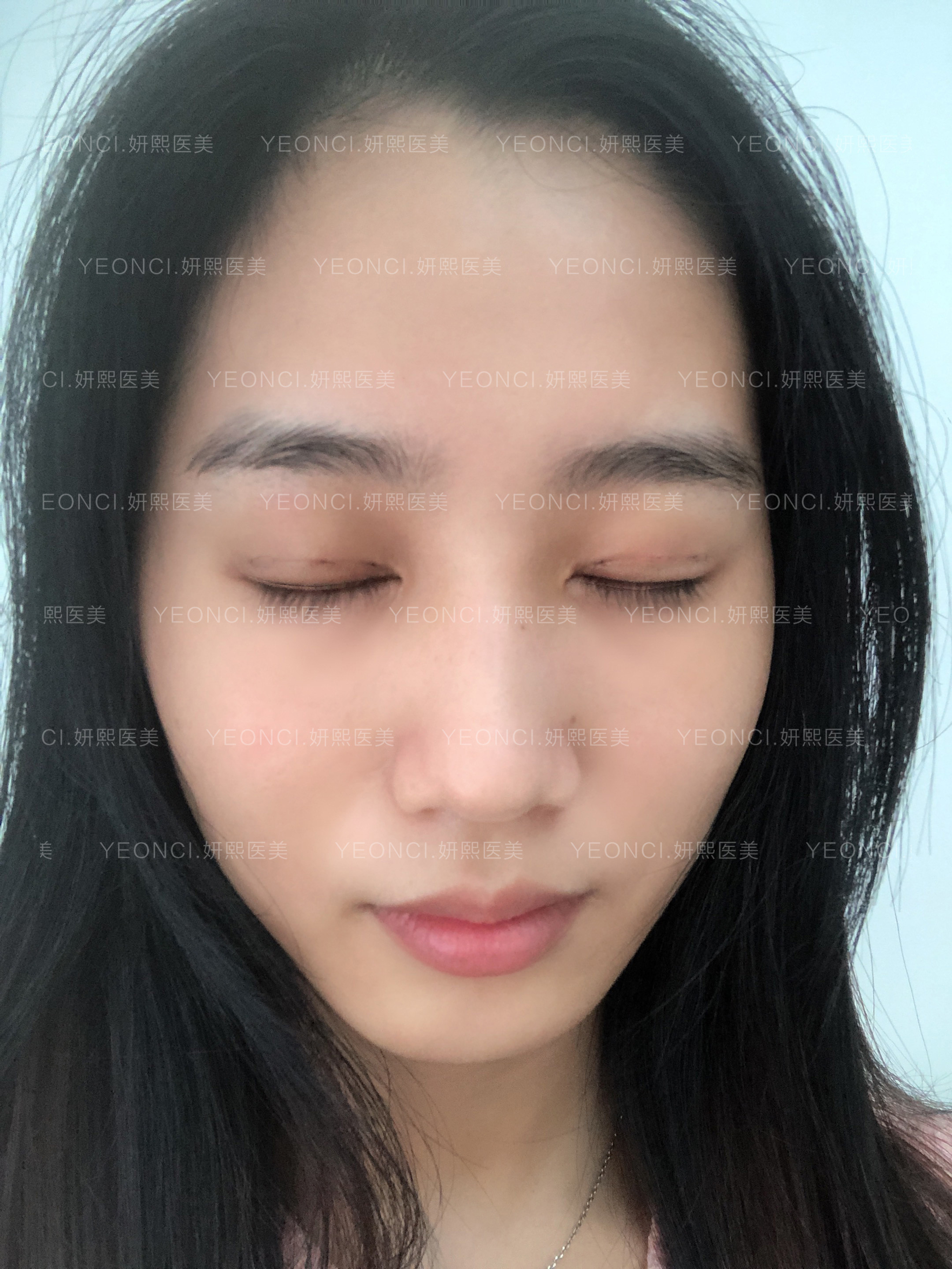 韩式三点定位双眼皮案例适合眼部基础较好,皮肤没有松