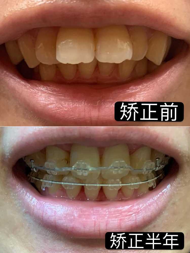 也影响个人的面貌 矫正方案:拔四颗正畸牙,排齐牙齿,收缝～ 矫正周期