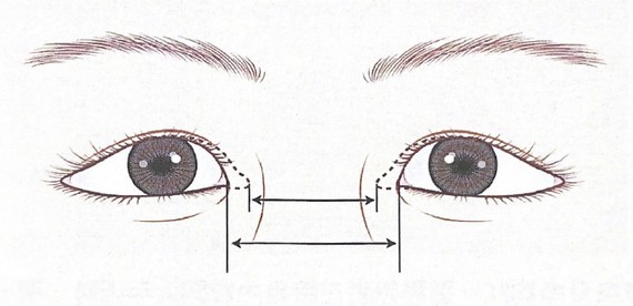 客观理解内眦角间距与内眦赘皮间距,以便更好厘清开内眼角手术