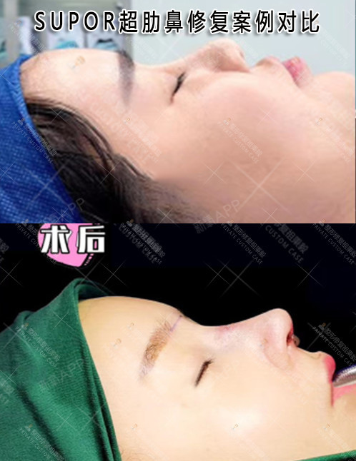 超肋隆鼻【supor超肋鼻部多项】术前该求美者鼻小_圈子-新氧美容整形