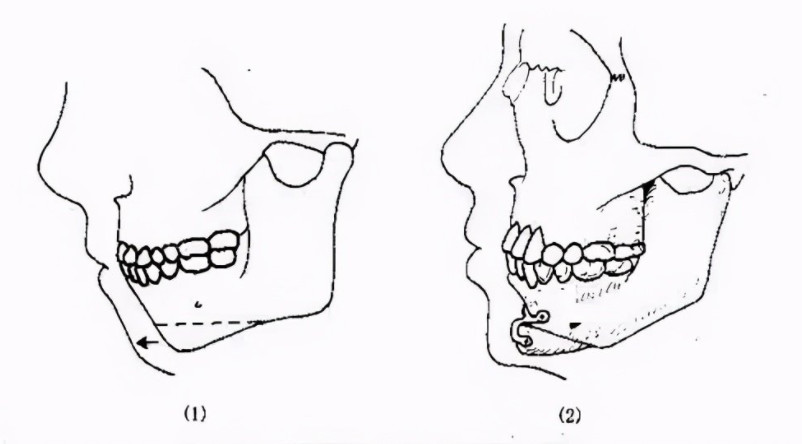 下颏是下面部轮廓的重要结构组成,颏部审美的关键是三维衡量 中立位置
