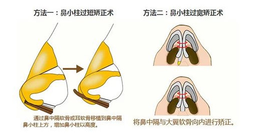 1,鼻中隔尾侧端长度不足或缺失2,鼻前棘和上颌骨发育不良3,瘢痕挛缩