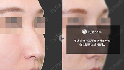 箭鼻整形,矫正鼻尖下垂,改善成柔和的印象箭头鼻子是_圈子-新氧美容