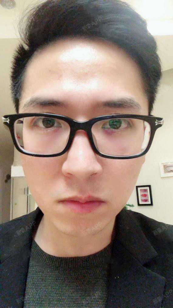 氧气xtguj外切去眼袋第0天美丽日记-新氧美容整