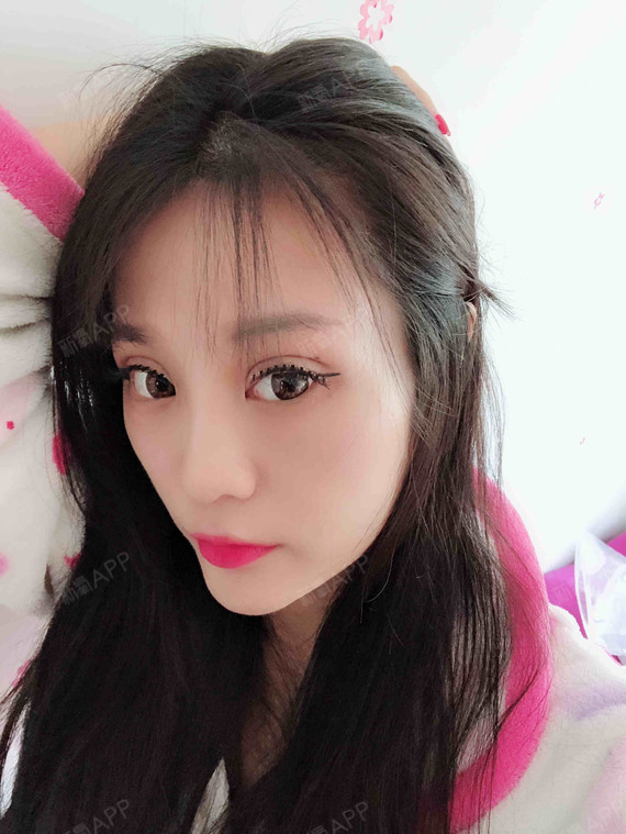 肥仔快乐水开内眼角第259天美丽日记-新氧美容