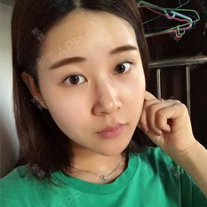 占戈占戈克克克克外切去眼袋第26天美丽日记