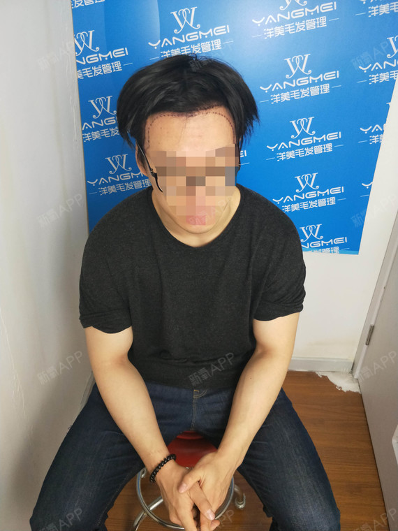 氧气5262101529399922种植发际线第0天美丽