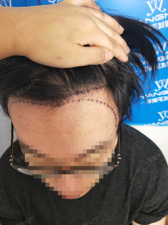 氧气5262101529399922种植发际线第0天美丽