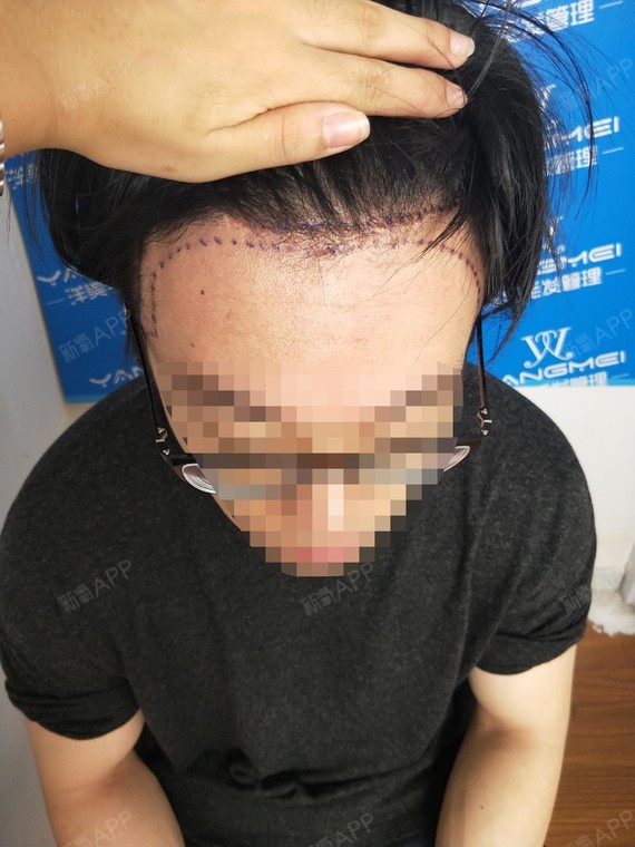 氧气5262101529399922种植发际线第0天美丽