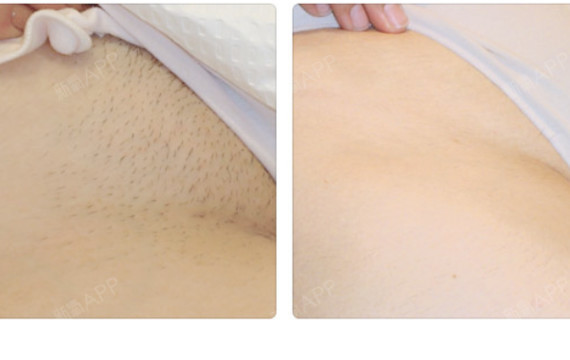 大连比基尼线脱毛好不好_效果图_氧气x8a1q比基尼线术